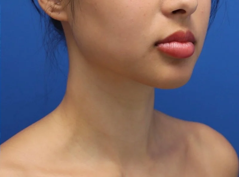 After Image: Precision Sculpt® — chin, neck, and jawline - right-front-oblique