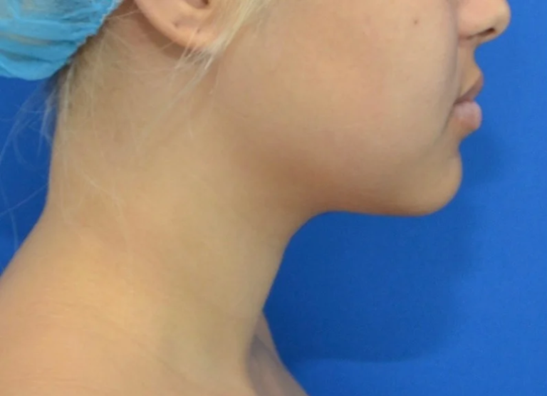 Before Image: Precision Sculpt® — chin, neck, and jawline - right-side