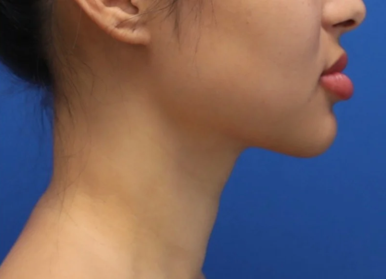 After Image: Precision Sculpt® — chin, neck, and jawline - right-side