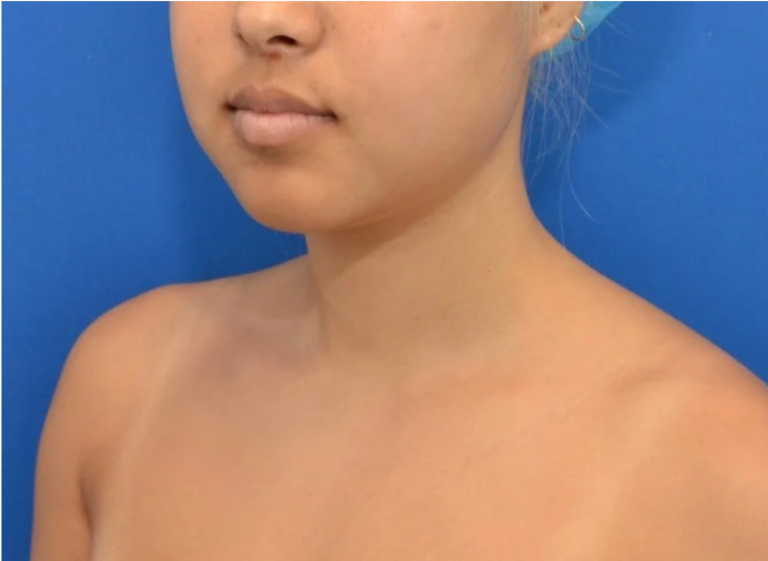Before Image: Precision Sculpt® — chin, neck, and jawline - left-front-oblique