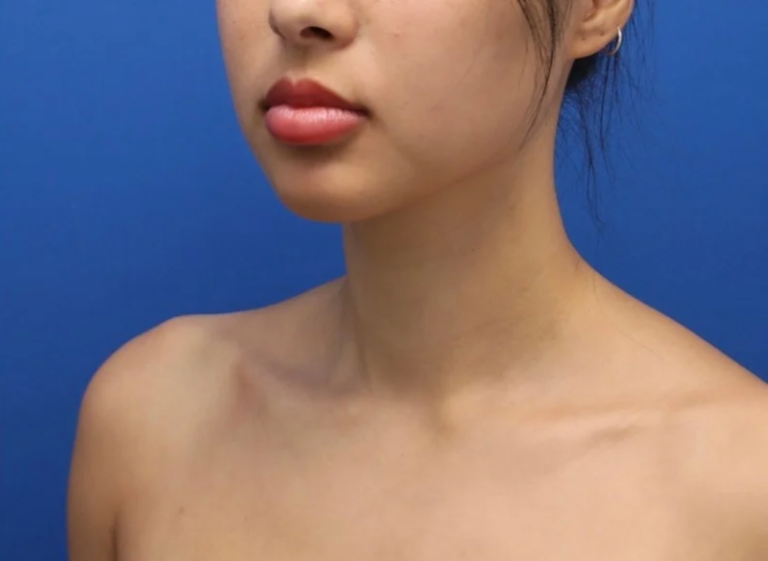 After Image: Precision Sculpt® — chin, neck, and jawline - left-front-oblique