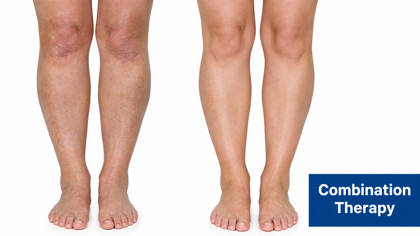 A comparison showing legs before and after cosmetic cellulite reduction treatment, highlighting improved skin texture and smoothness.
