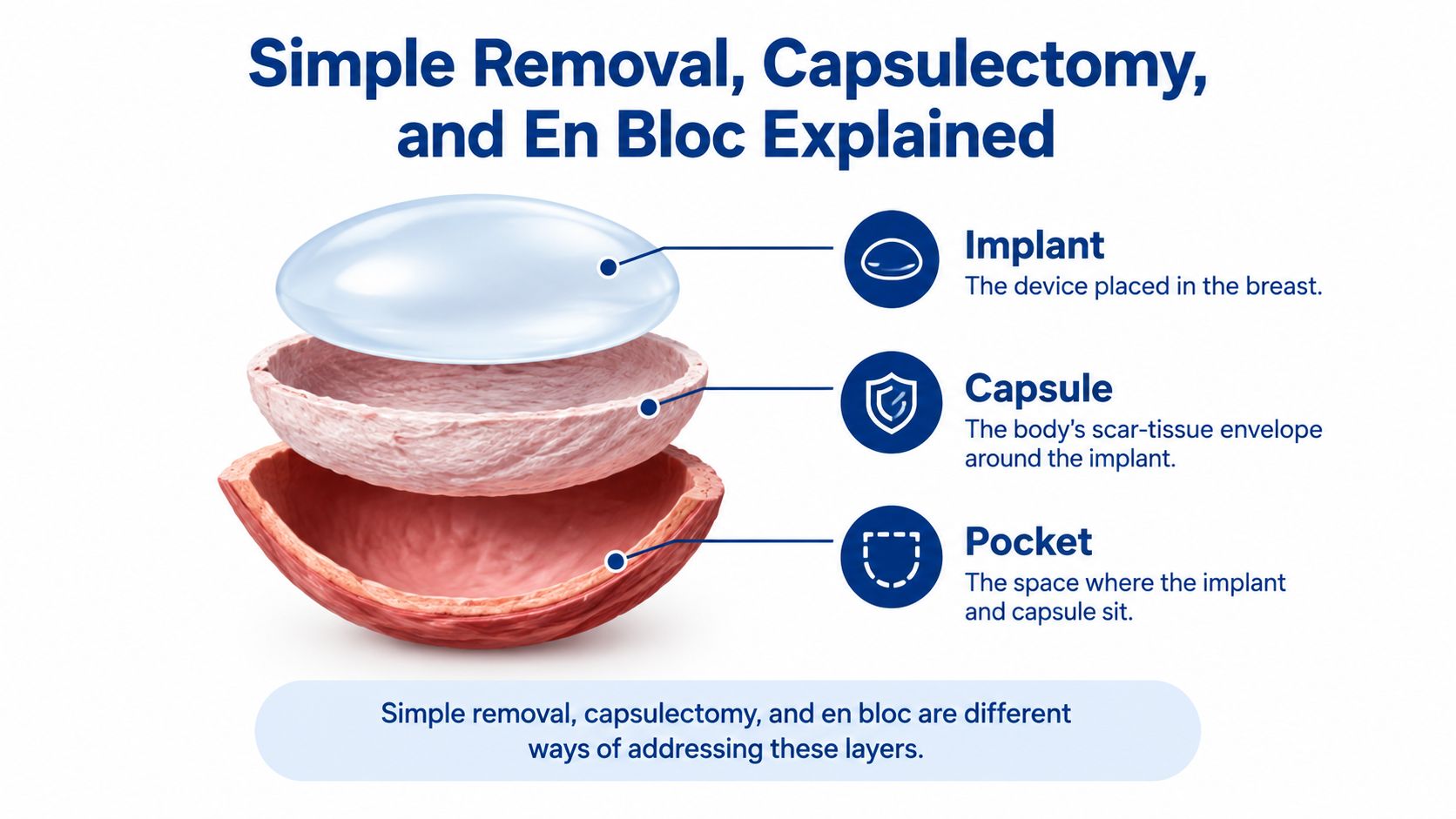 A medical illustration explaining breast implant anatomy, including the implant, surrounding scar tissue capsule, and the pocket.