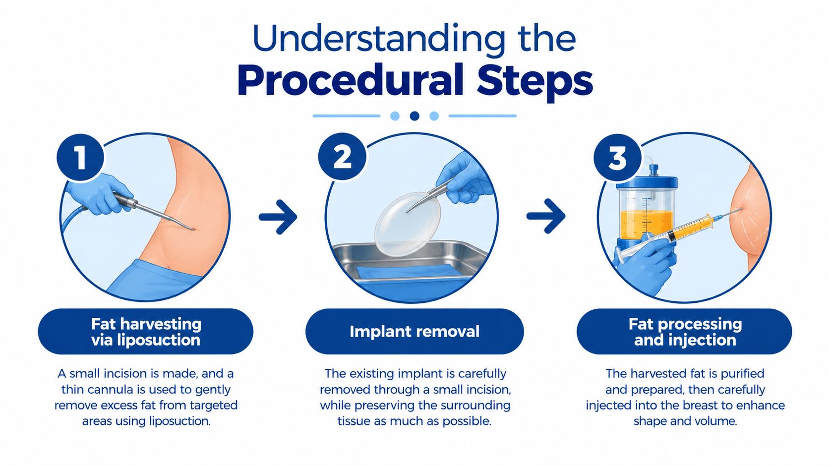 An infographic illustrating the three steps of a breast implant removal and fat transfer procedure.