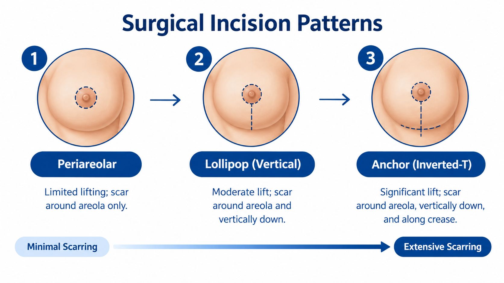 A diagram illustrating three surgical incision patterns for breast lifts, comparing minimal to extensive scarring methods.