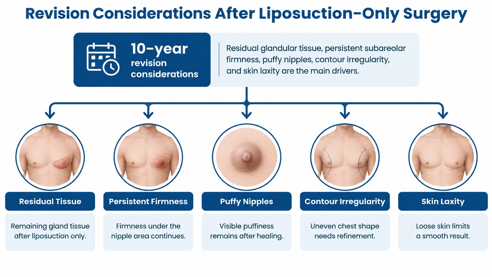 A diagram outlining the common causes and considerations for revision surgery after initial liposuction-only gynecomastia treatment.