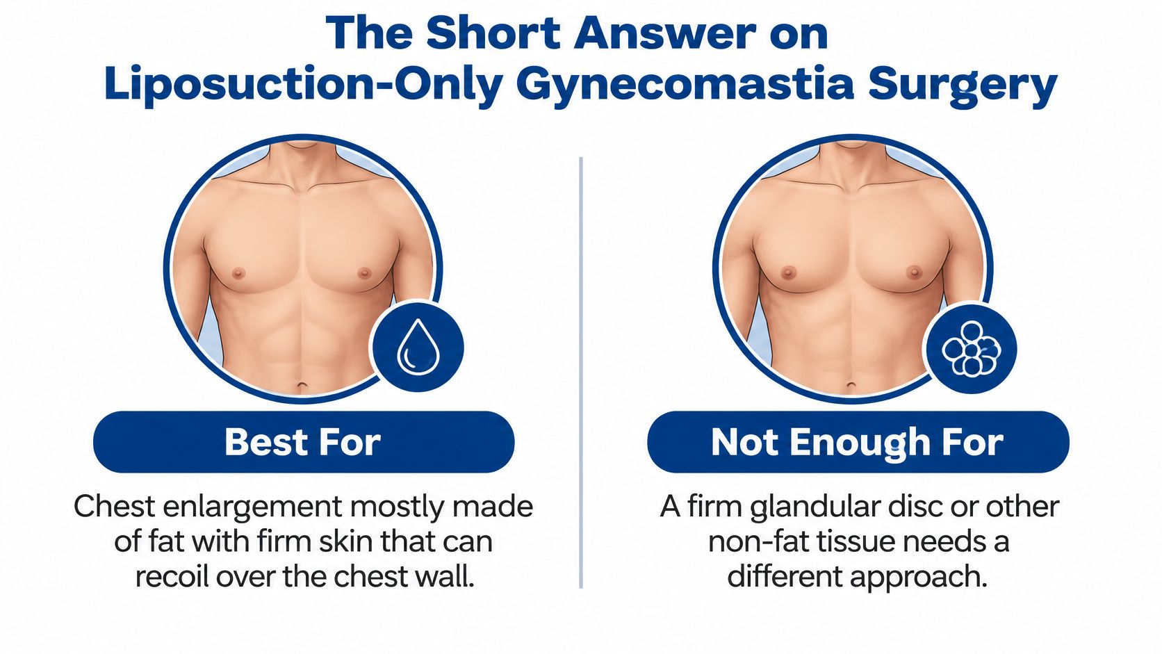 A diagram explaining when liposuction-only surgery is suitable for gynecomastia versus cases needing a different approach.