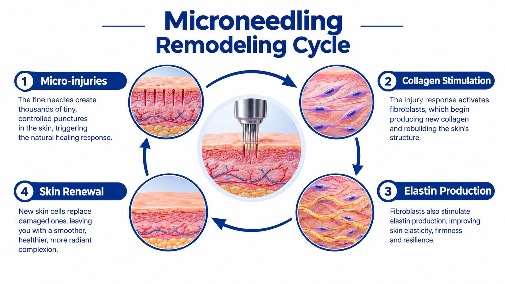 A diagram illustrating the four-step microneedling remodeling cycle for skin rejuvenation and collagen production.