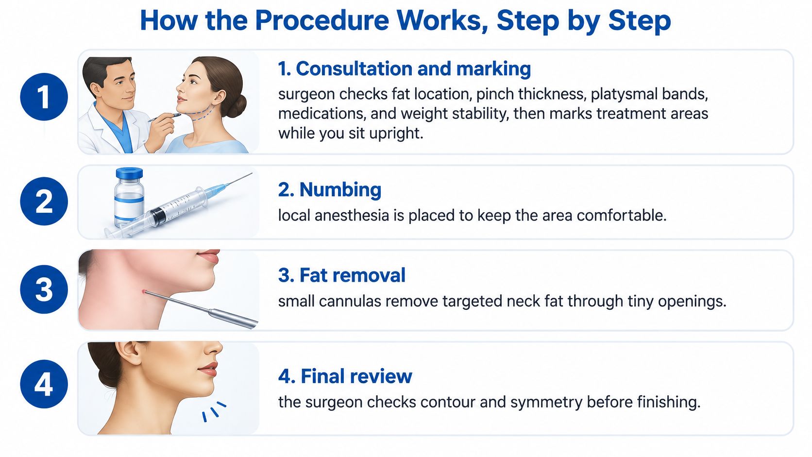A four-step infographic illustrating the medical procedure for neck fat removal using liposuction techniques.