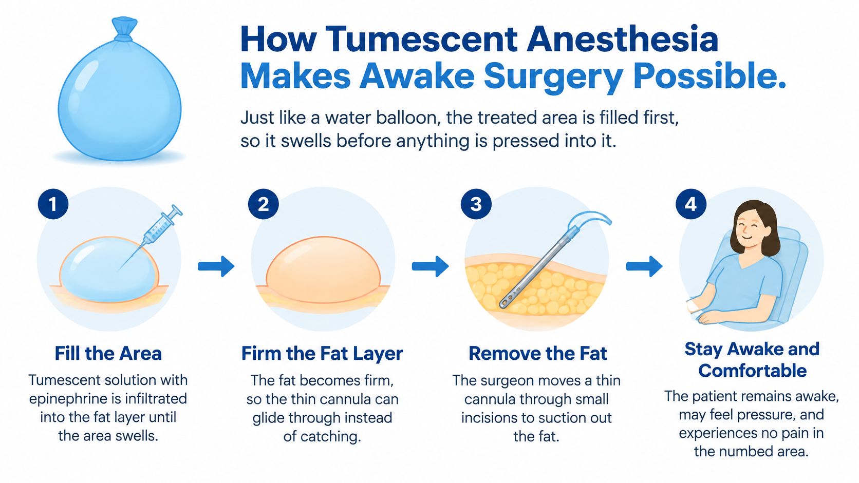 An infographic showing the four steps of the tumescent liposuction process that enables awake surgery for patients.