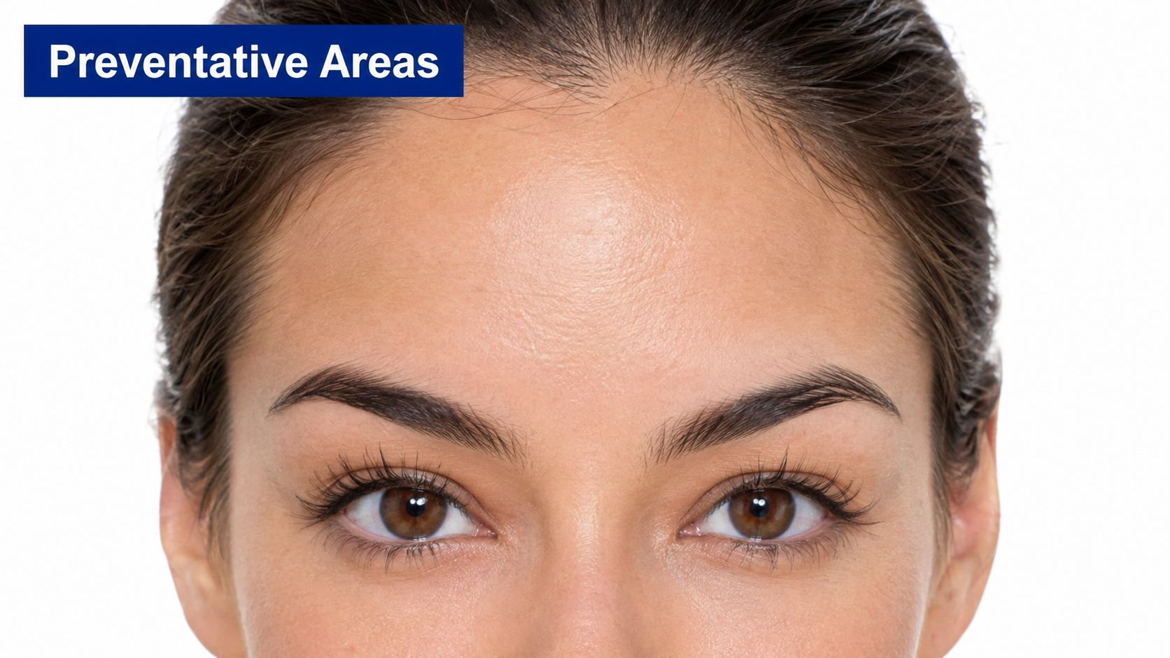 A close-up view of a woman's forehead and eyes, illustrating areas for preventative botox treatment.